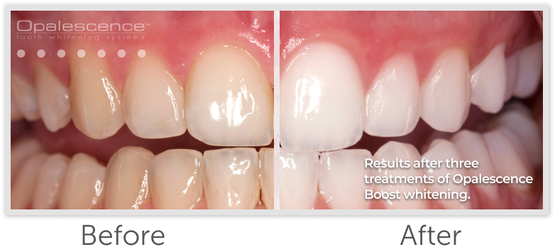 Opalescence Boost Before and After