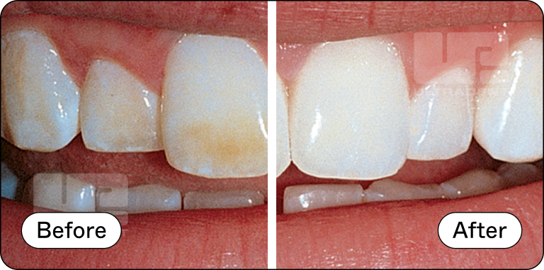 Opalescence Custom Before and After 6