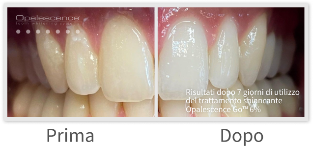 Opalescence Go Before and After