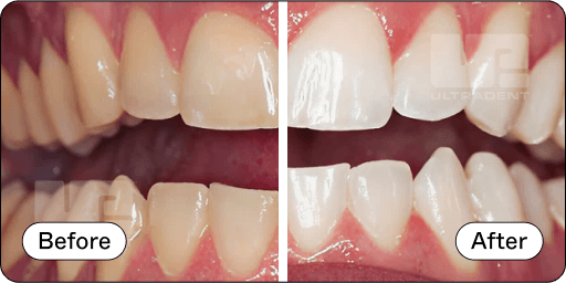 Opalescence Pro Before and After 4