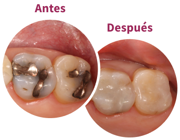 Amalgam Fillings