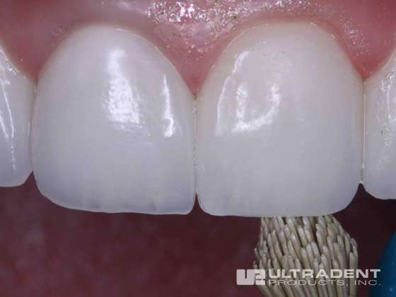 Dental Porcelain repair kit silane etching drying agent soft dental dam