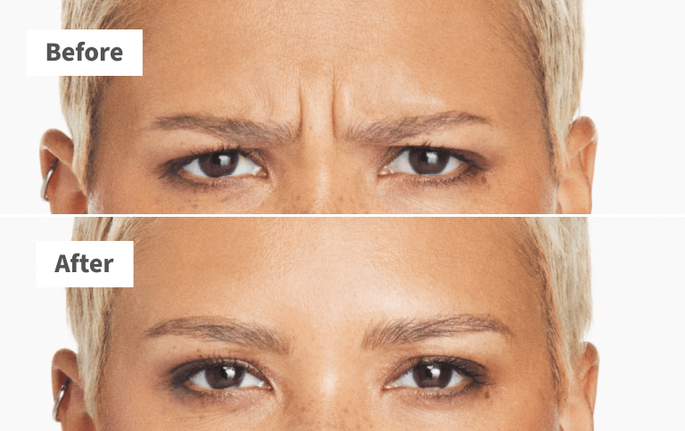 Alexis, frown lines before and after