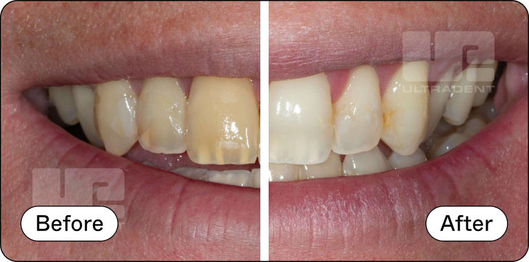 Opalescence Go Advanced Before and After 1