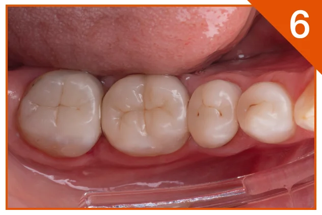 Posterior onlay one year follow-up