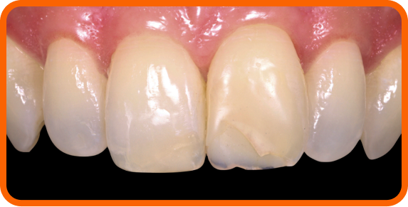 Failing restoration on tooth #9