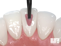 Opalescence Endo Procedure - Walking Bleach Technique 3