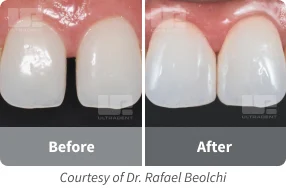 vit-l-escence teeth before after 2