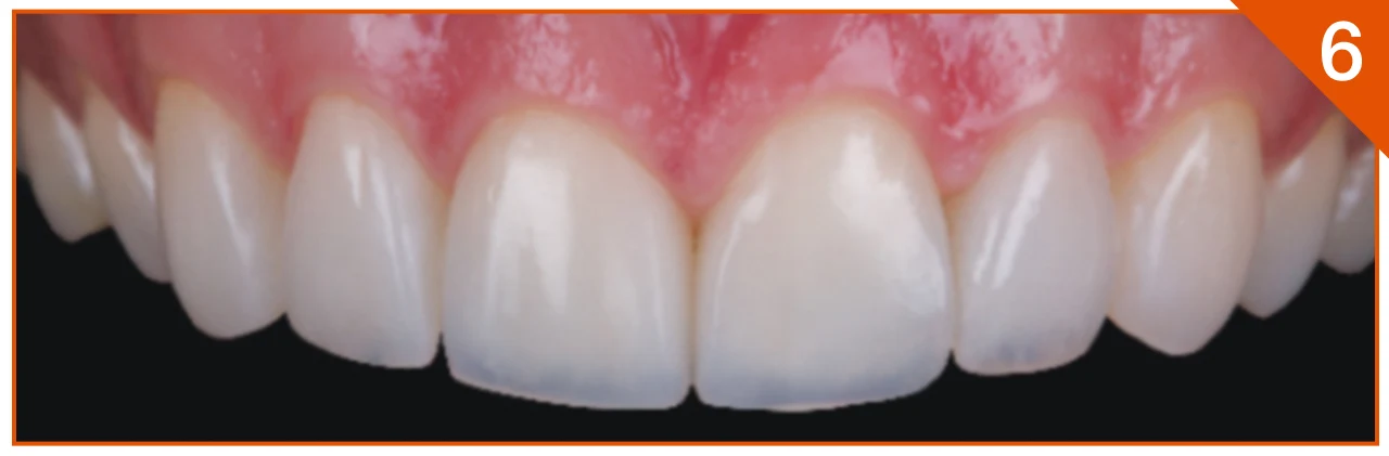 Final polished diastema closure result