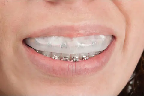 Position tray on teeth