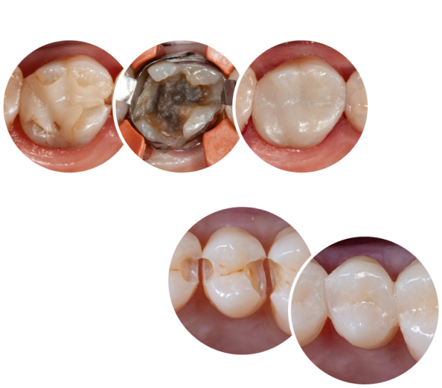 direct bonded restoration