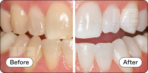 Opalescence Pro Before and After 1