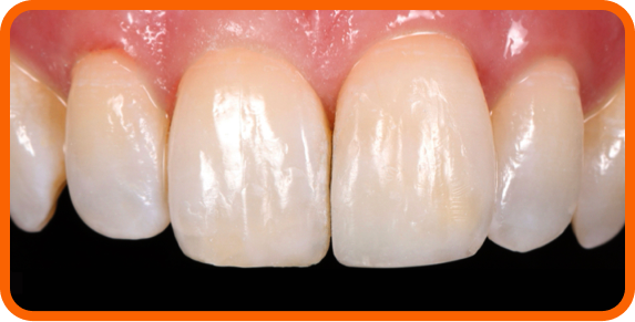 Restoration was completed with FORMA S composite shades A2B, A2E, and BL1