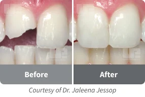 vit-l-escence teeth before after 1