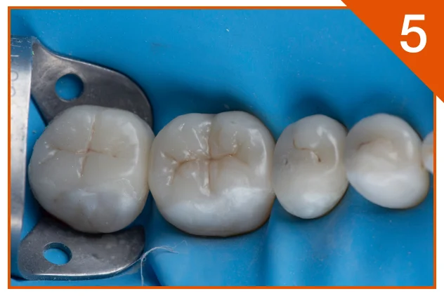 Restoration in place after luting and polishing