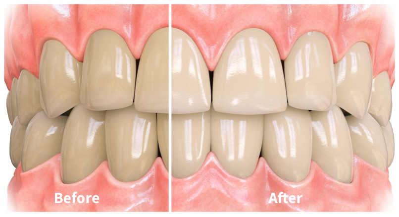 Opalescence Toothpaste Before and After