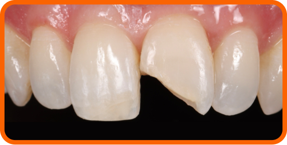 Old restoration was removed and tooth was prepped