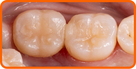 Restoration was completed with PermaFlo™ flowable composite and FORMA S composite shades A2E and A2B