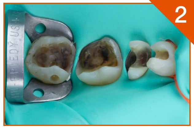 Removal of restorations with rubber dam isolation