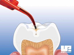 UltraSeal XT™ plus-Hydrophobic Pit and Fissure Sealant