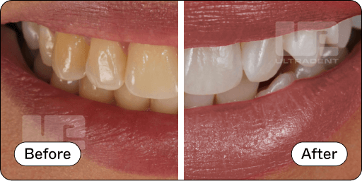 Opalescence Pro Before and After 2