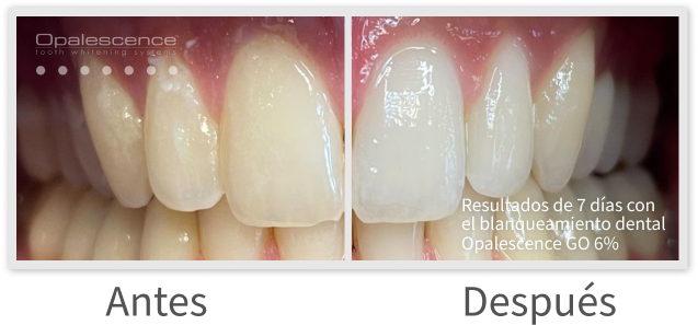 Opalescence Go Before and After