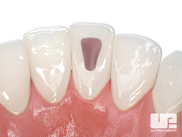 Opalescence Endo Procedure - Walking Bleach Technique 5