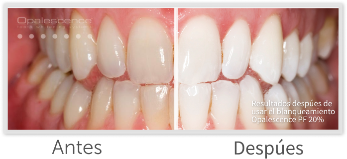 Opalescence PF Before and After