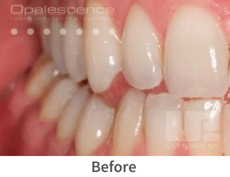 Opalescence whitening before