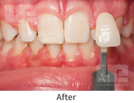 Opalescence whitening after