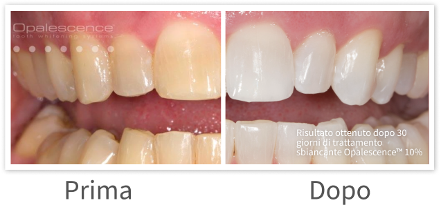 Opalescence PF Before and After