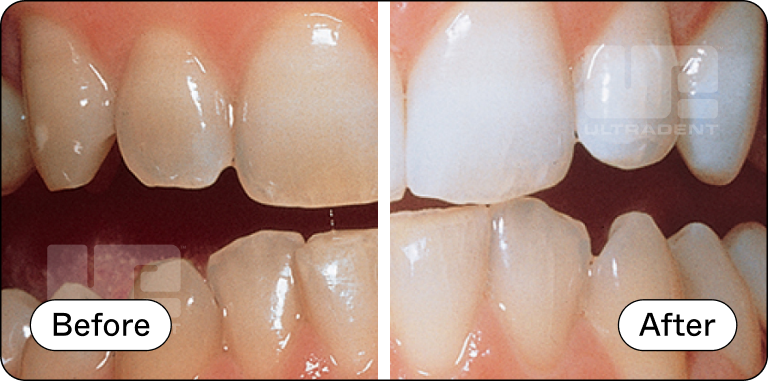 Opalescence Custom Before and After 1