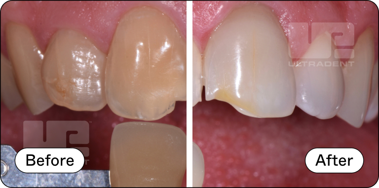 Opalescence Custom Before and After 5