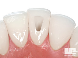 Opalescence Endo Procedure - Walking Bleach Technique 1