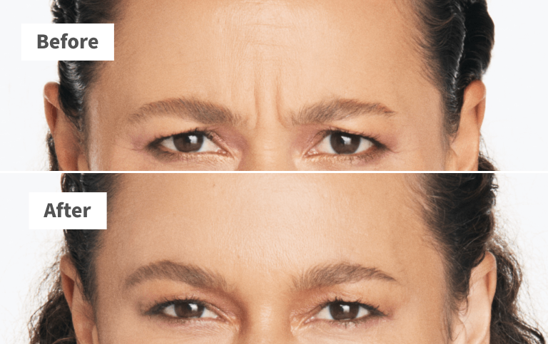 Erin, frown lines before and after