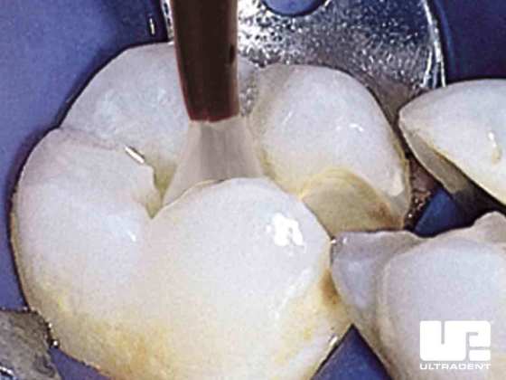 Ultradent Black Mini Brush Tip – Clinical Research Dental