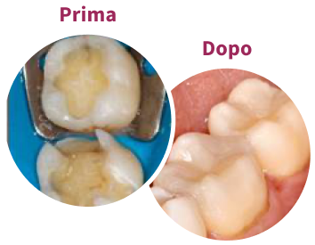 Lower Molars Restored