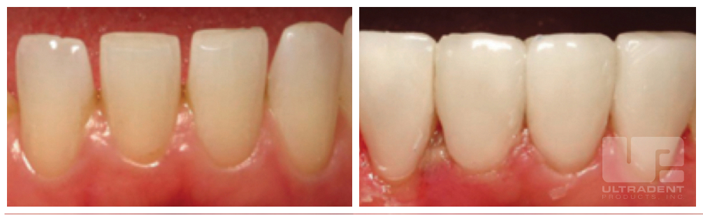 Uveneer before and after courtesy of Dr. Hal Stewart.