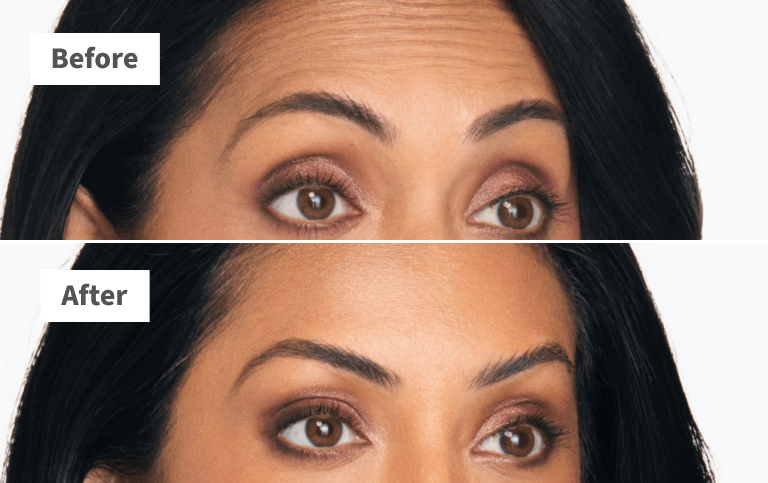 Riya, forehead lines lines before and after