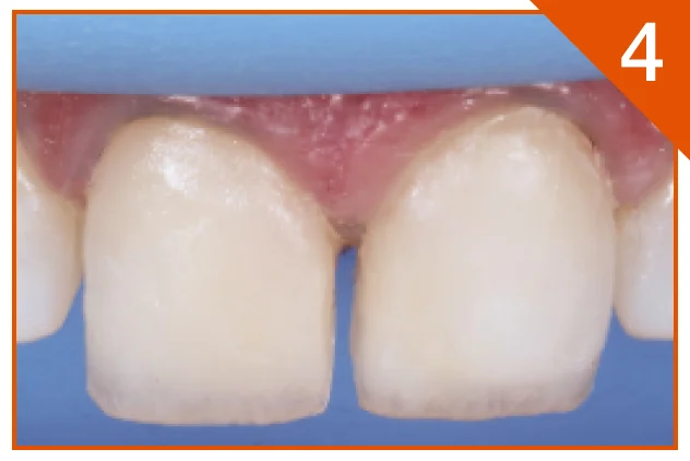 Superficial dentine and bevel area covered with A1B shade