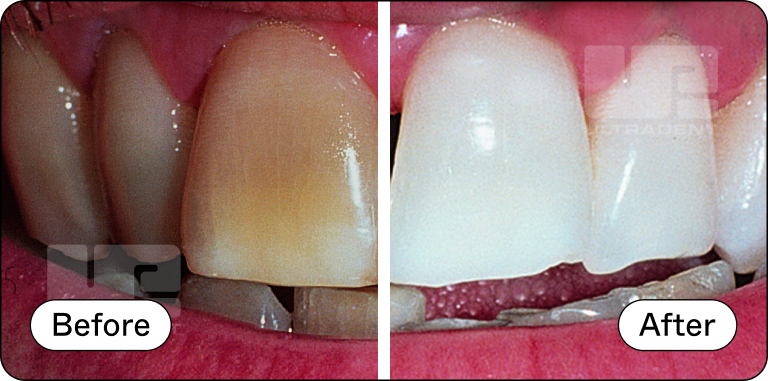 Opalescence Custom Before and After 2