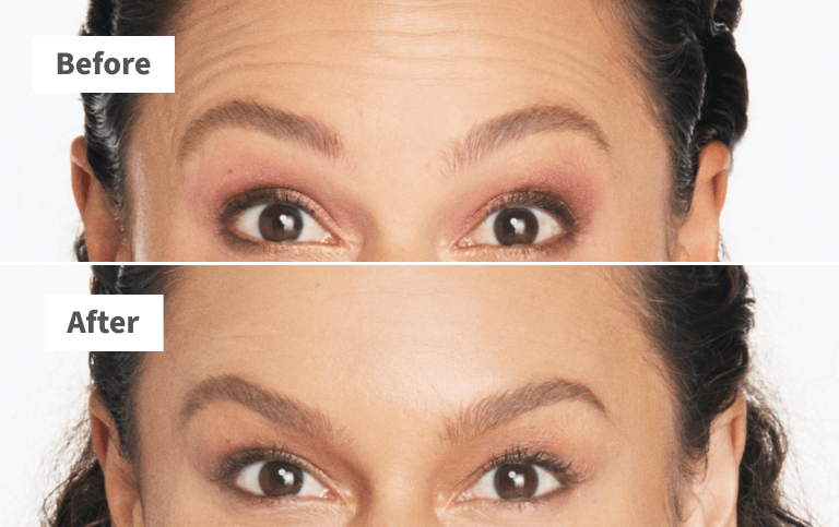 Erin, forehead lines before and after