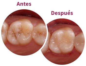 Caries and defective restoration