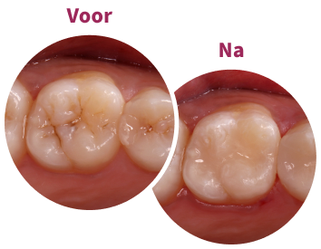 Caries and defective restoration