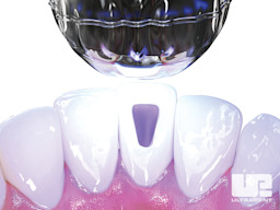 Opalescence Endo Procedure - Walking Bleach Technique 4