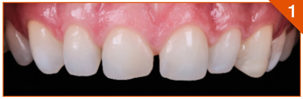 Initial diastema closure case