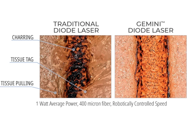 Gemini Laser Comparison