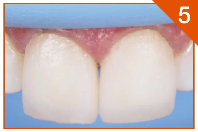 Enamel bleach shade XWE used