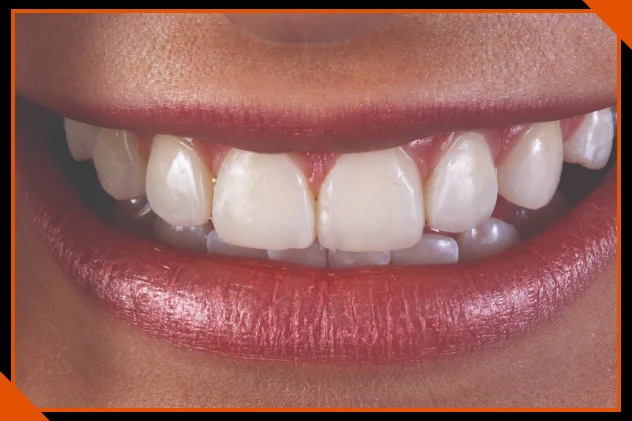 Anterior restoration result