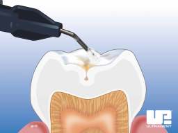 Ultraseal Xt™ Plus-hydrophobic Pit And Fissure Sealant